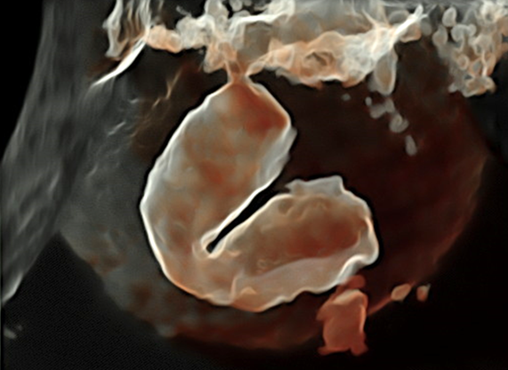 Advanced Gynecology Ultrasound