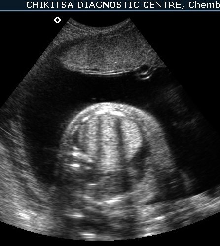 Bronchial Atresia using Ultrasound 1
