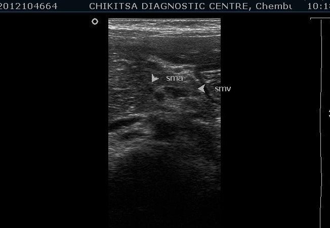 Diagnosis of Mid-gut volvulus using Ultrasound - ultrasoundchikitsa.in Diagnosis of Mid-gut volvulus using Ultrasound