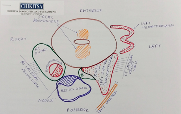 Endometriosis Ultrasound and Mapping