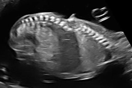 Fetal Neurosonography