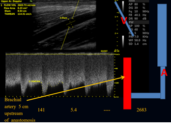 Hemodialysis Ultrasound