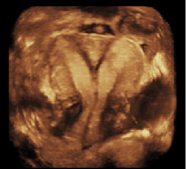 Infertility Ultrasound