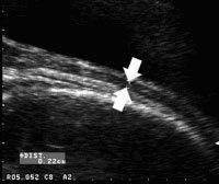LSCS Scar 3 - ultrasoundchikitsa.in LSCS Scar 3
