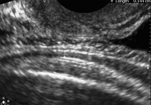 LSCS Scar 4 - ultrasoundchikitsa.in LSCS Scar 4