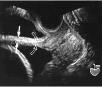 LSCS Scar 5 - ultrasoundchikitsa.in LSCS Scar 5