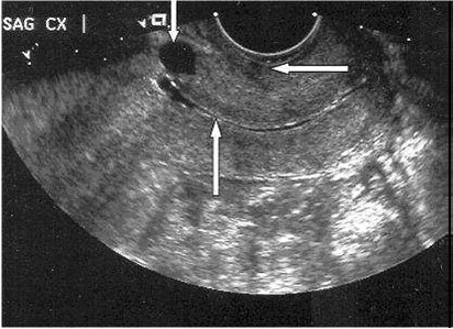 LSCS Scar 6 - ultrasoundchikitsa.in LSCS Scar 6