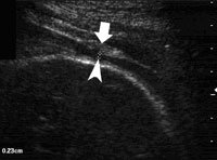 LSCS Scar 7 - ultrasoundchikitsa.in LSCS Scar 7