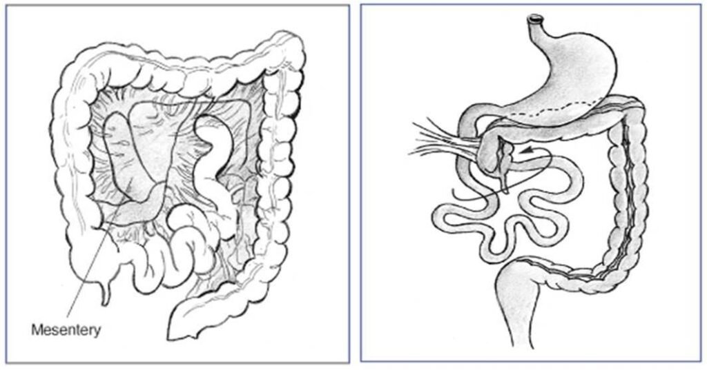 Mesentry Ultrasound - ultrasoundchikitsa.in Mesentry Ultrasound