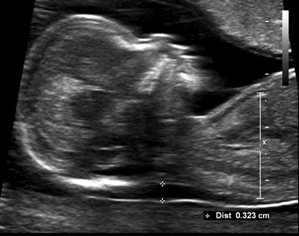 Nuchal translucency and 1st trimester screening