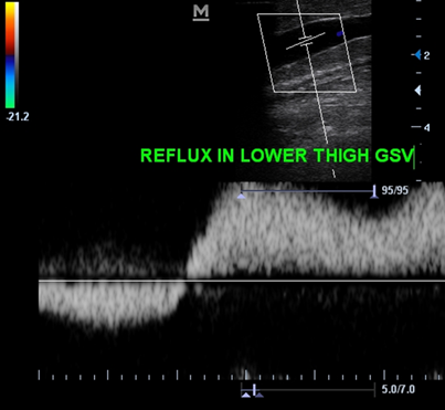 Peripheral Doppler Program