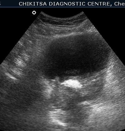 Schistosomiasis of Urinary Bladder 1