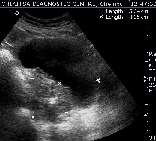 Schistosomiasis of Urinary Bladder 2 - ultrasoundchikitsa.in Schistosomiasis of Urinary Bladder 2