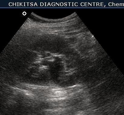 Schistosomiasis of Urinary Bladder 3 - ultrasoundchikitsa.in Schistosomiasis of Urinary Bladder 3