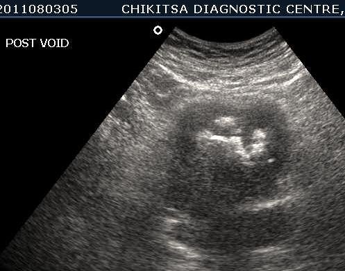 Schistosomiasis of Urinary Bladder 4 - ultrasoundchikitsa.in Schistosomiasis of Urinary Bladder 4