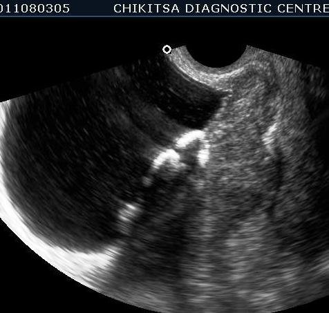 Schistosomiasis of Urinary Bladder 5 - ultrasoundchikitsa.in Schistosomiasis of Urinary Bladder 5