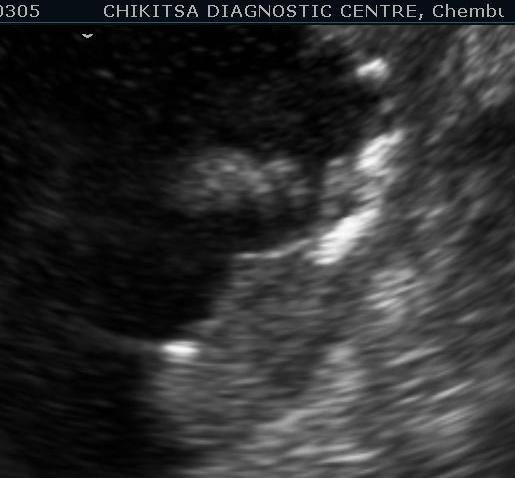 Schistosomiasis of Urinary Bladder 6 - ultrasoundchikitsa.in Schistosomiasis of Urinary Bladder 6