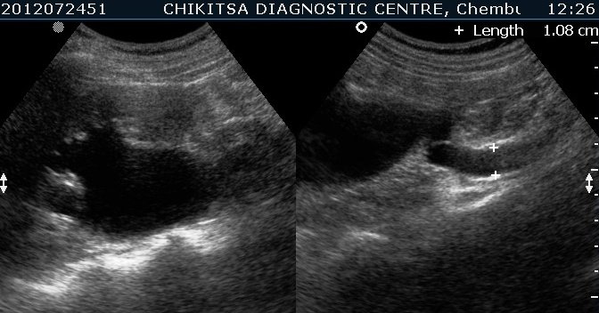 Schistosomiasis of Urinary Bladder 8 - ultrasoundchikitsa.in Schistosomiasis of Urinary Bladder 8