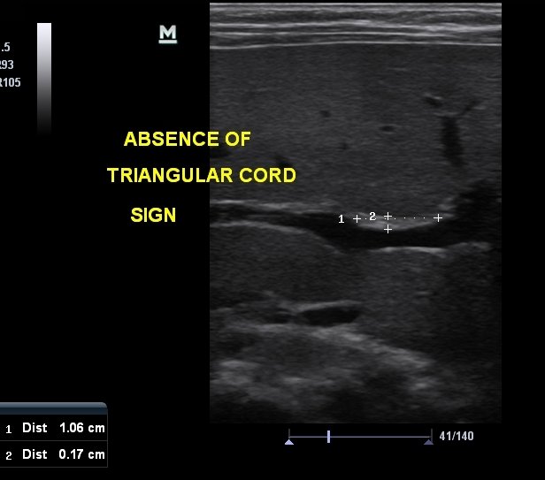 Triangular Cord Sign Of Biliary Atresia Ultrasound Module 1