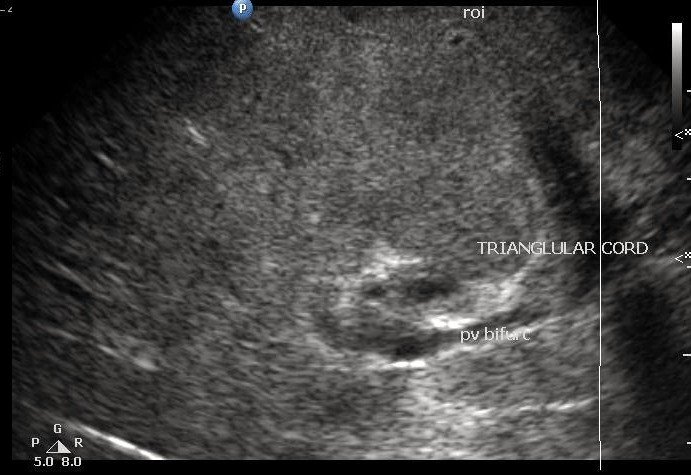 Triangular Cord Sign Of Biliary Atresia Ultrasound Module 2 - ultrasoundchikitsa.in Triangular Cord Sign Of Biliary Atresia Ultrasound Module 2