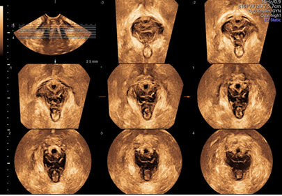 Urogynecology Ultrasound